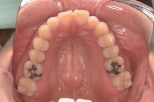 治療前（写真2）