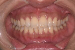 治療前（写真1）