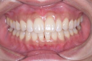 治療後（写真1）