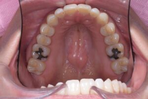 治療後（写真2）