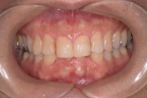 治療前（写真1）