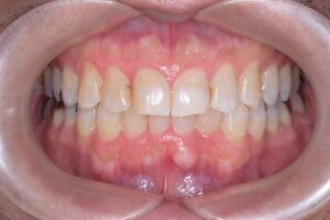 治療後（写真1）