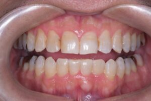 治療後（写真2）