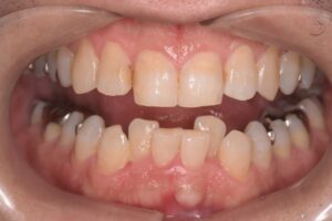 治療前（写真2）