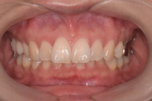 治療前（写真1）