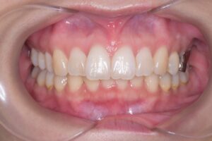 治療後（写真1）