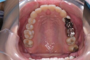 治療後（写真2）