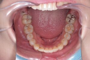 治療後（写真3）