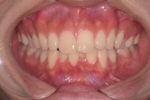 治療前（写真1）