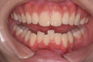 治療前（写真2）