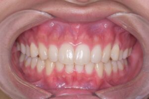 治療後（写真1）