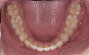 治療後（写真3）