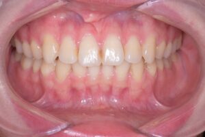 治療後（写真1）