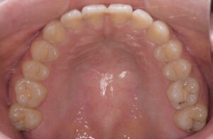 治療後（写真2）