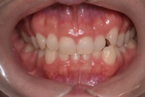 治療前（写真1）