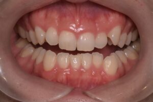 治療前（写真2）