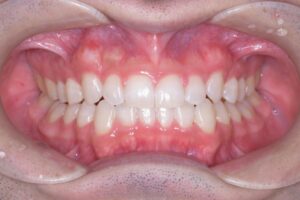 治療後（写真1）