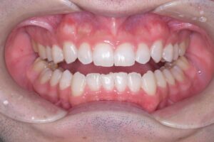 治療後（写真2）