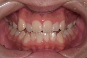 治療前（写真1）