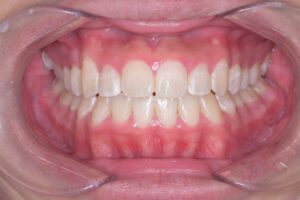 治療後（写真1）