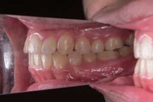 治療後（写真2）