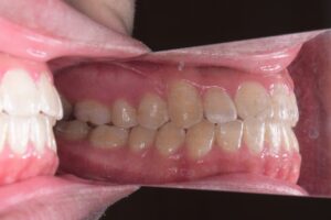 治療後（写真3）