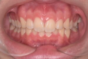 治療前（写真1）