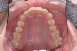 治療前（写真2）