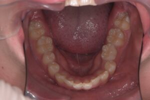 治療前（写真3）