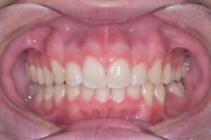 治療後（写真1）