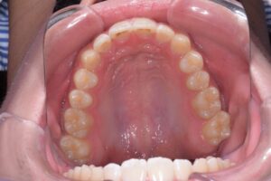 治療後（写真2）