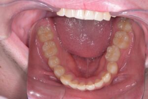 治療後（写真3）