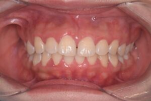 治療前（写真1）