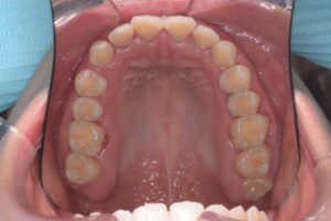 治療前（写真2）