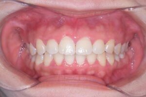 治療後（写真1）