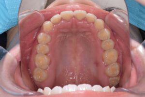 治療後（写真2）