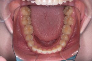 治療後（写真3）