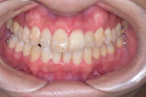 治療後（写真1）