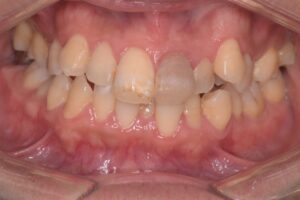 治療前（写真1）