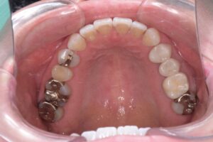 治療後（写真2）