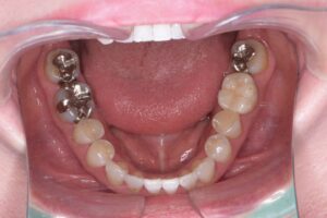 治療後（写真3）