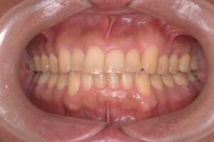 治療前（写真1）