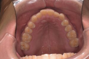 治療前（写真2）