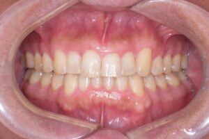 治療後（写真1）