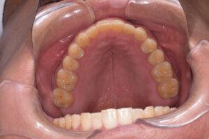 治療後（写真2）