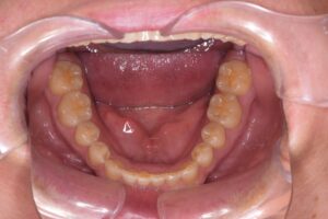 治療後（写真3）