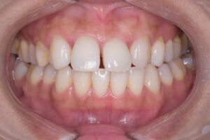 治療前（写真1）