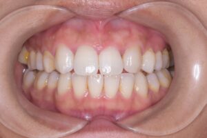 治療後（写真1）