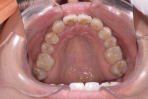 治療後（写真2）