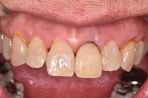 治療後（写真1）